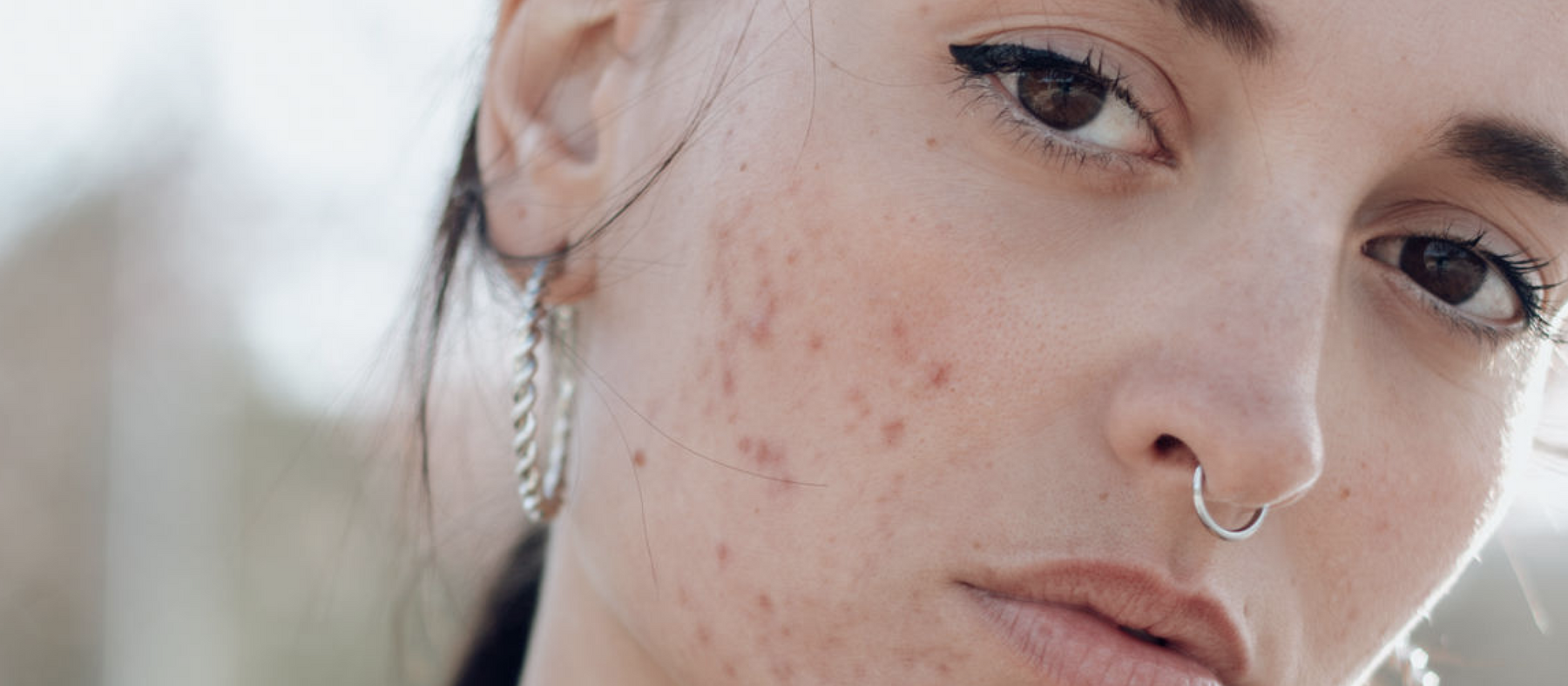 how to deal with adult acne