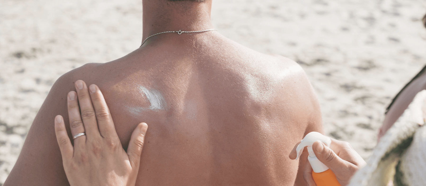How to care for a sunburn