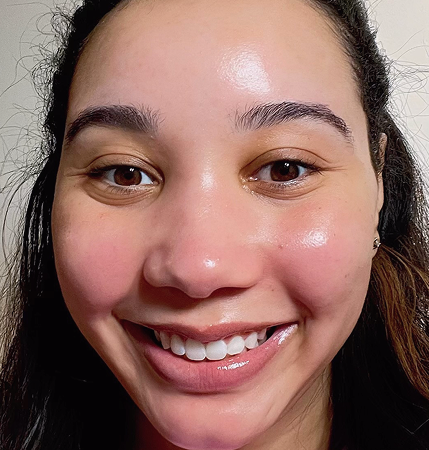 Post facial image showing results of acne clear-up