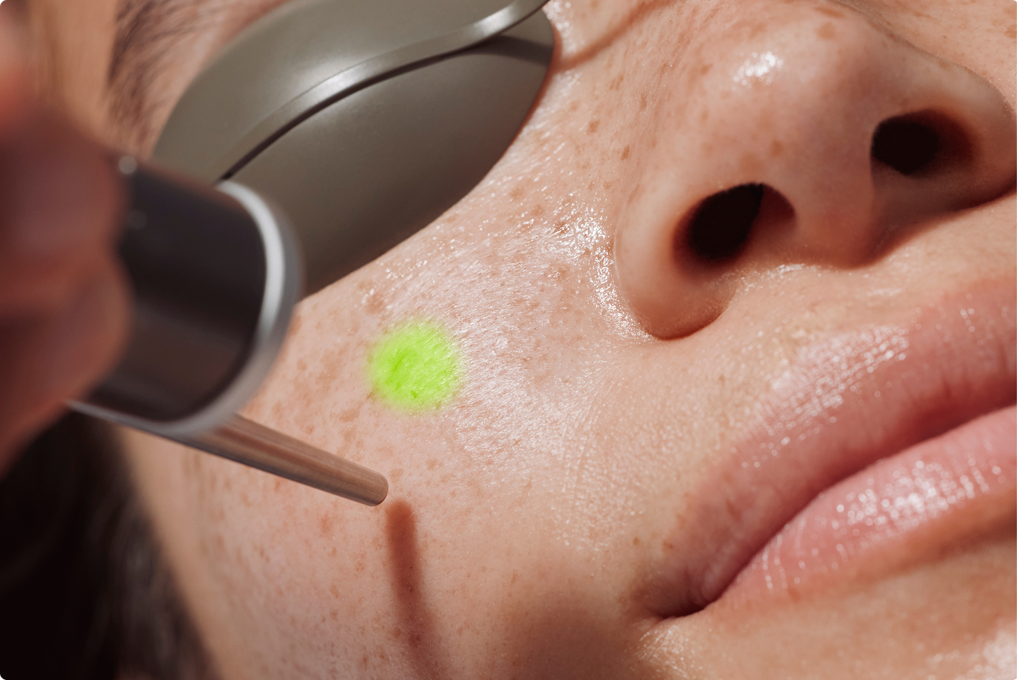 Heyday client getting a laser facial