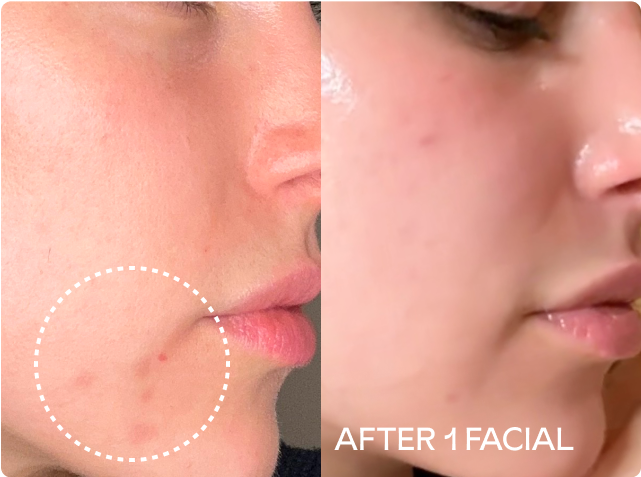 Before and after of one facial shows improvement of breakouts and dark spots on skin