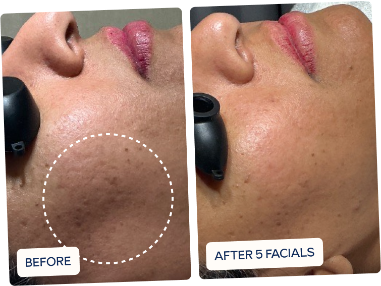 After five laser facials skin texture is refined and dark spots have faded