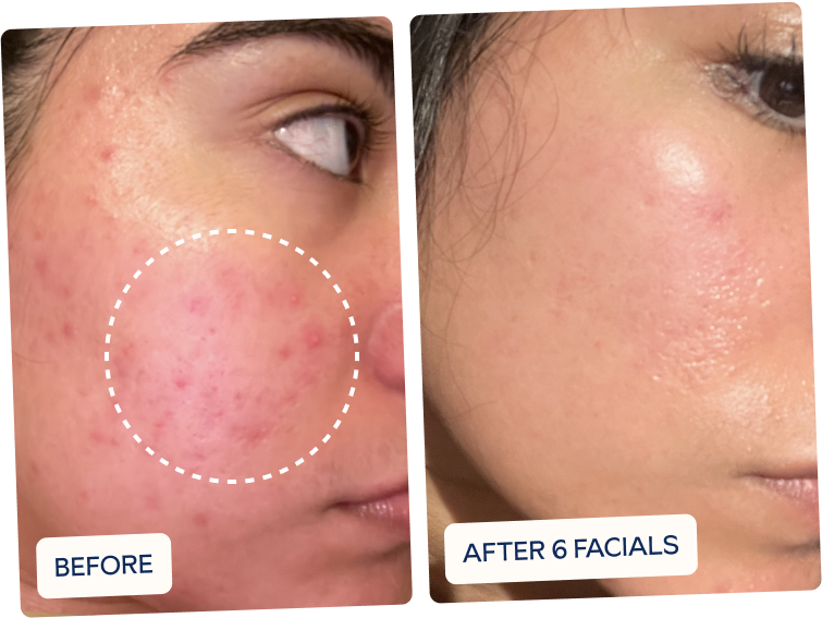 after six facials acne has been cleared up