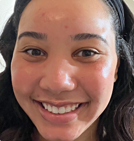 Post facial image showing results of acne clear-up