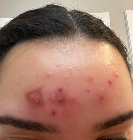Before image of someone getting a facial to address acne